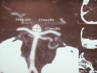 AngioTAC pr� operat&oacute;rio, de aneurisma do topo da Basilar.