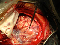 C&eacute;rebro - Estimula&ccedil;&atilde;o cerebral superficial.