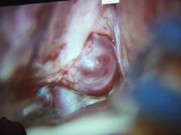 Aneurisma gigante paraclinoideo.