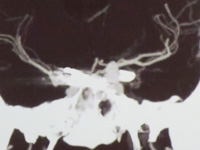 AngioTAc de aneurisma paraclinoideo esq&ordm;.