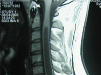 RMN pr&eacute; e p&oacute;s operat&oacute;rio de tumor intramedular cervical.