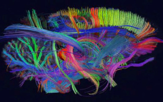 Tratografia cerebral